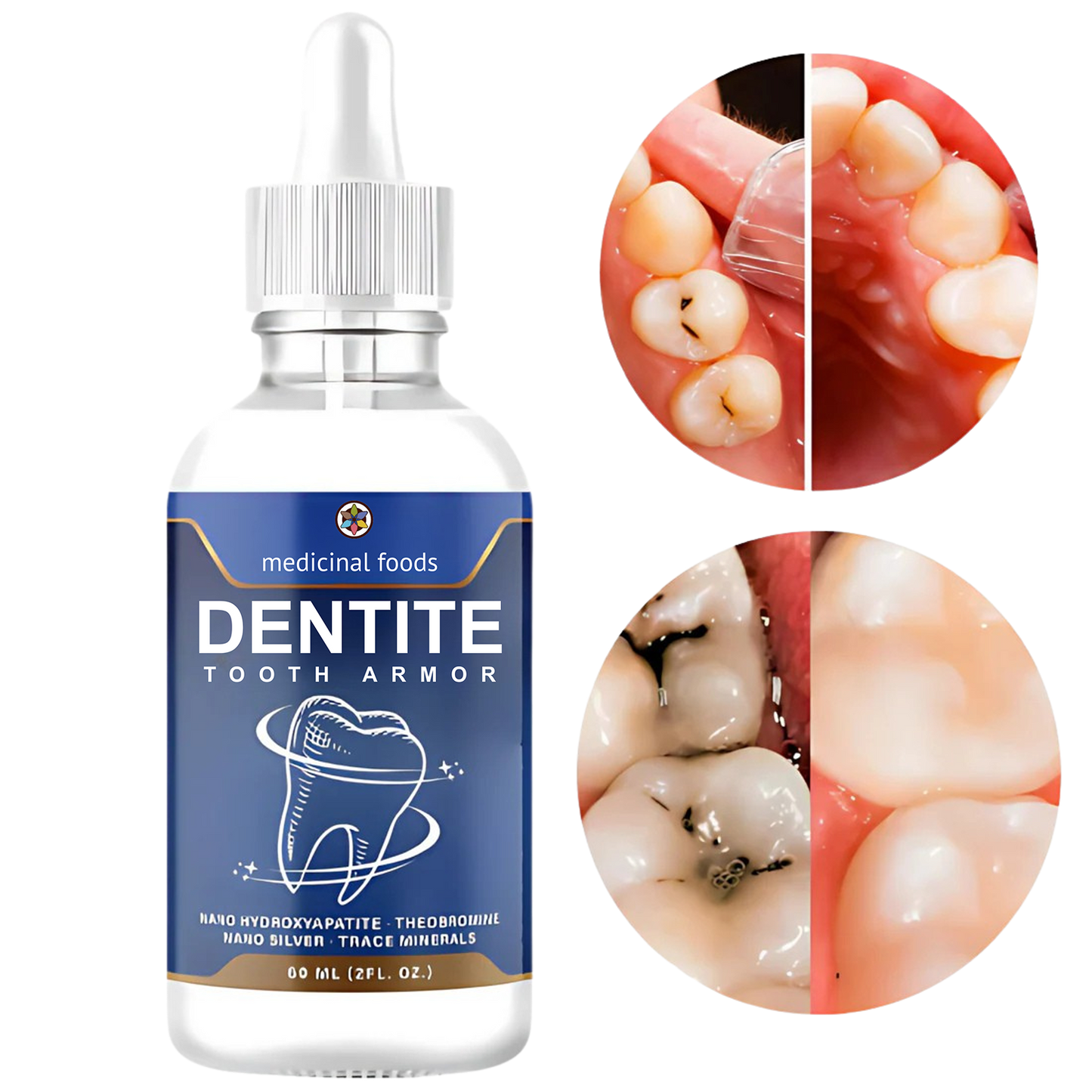 Dentite™ Tooth Armor
