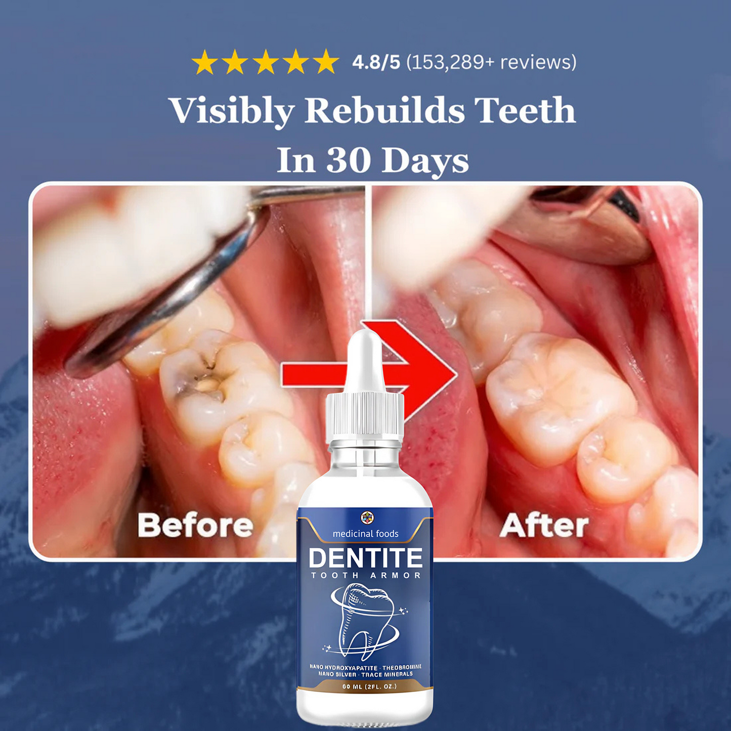 Dentite™ Tooth Armor